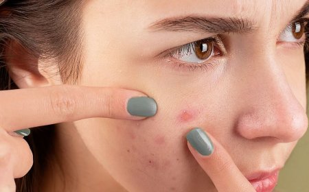 முகப்பருவால் தொல்லையா? முகப்பருவை கட்டுப்படுத்தும் எளிய வழிமுறைகள் இதோ!